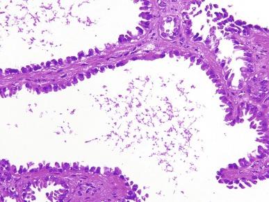 Fig. 2.83, Tubulocystic carcinoma.