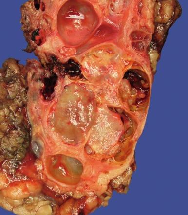 Fig. 2.84, Acquired cystic kidney disease–associated renal cell carcinoma.