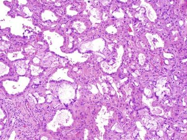 Fig. 2.85, Acquired cystic kidney disease–associated renal cell carcinoma.