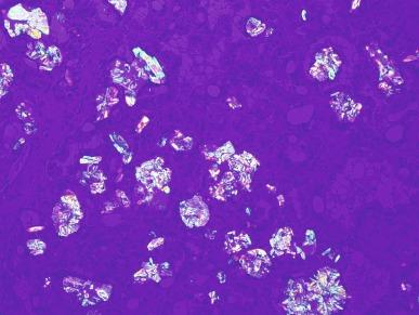 Fig. 2.86, Acquired cystic kidney disease–associated renal cell carcinoma.