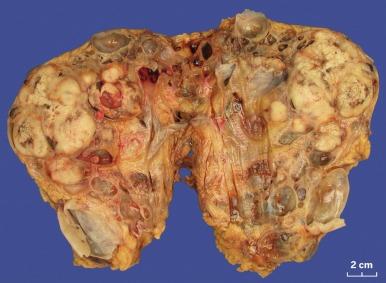 Fig. 2.87, Acquired cystic kidney disease–associated renal cell carcinoma with sarcomatoid features.
