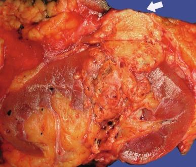 Fig. 2.9, Renal cell carcinoma extending into cortical fat and involving inked Gerota fascia ( arrow ).