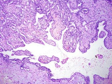 Fig. 2.91, Clear cell papillary renal cell carcinoma.