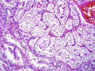 Fig. 2.92, Clear cell papillary renal cell carcinoma.