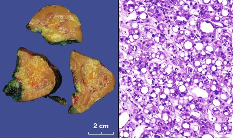 Fig. 2.93, Renal cell carcinoma, unclassified.