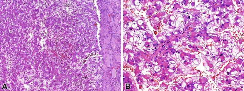 Fig. 2.94, Oncocytic renal cell carcinoma occurring after neuroblastoma.