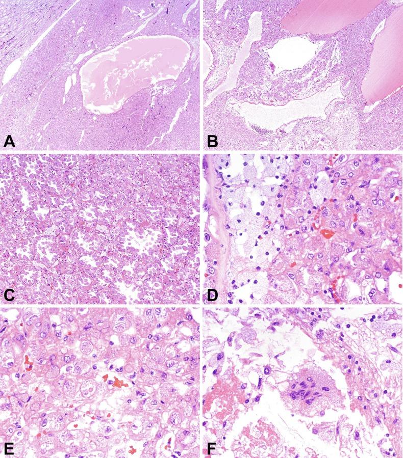 Fig. 2.95, Eosinophilic solid and cystic renal cell carcinoma.