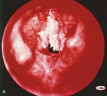 Fig. 16-1, Recurrent respiratory (laryngeal) papillomatosis.