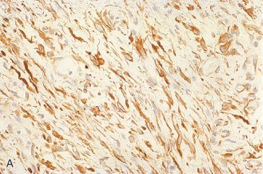 Fig. 16-11, Immunohistochemistry of IMT.