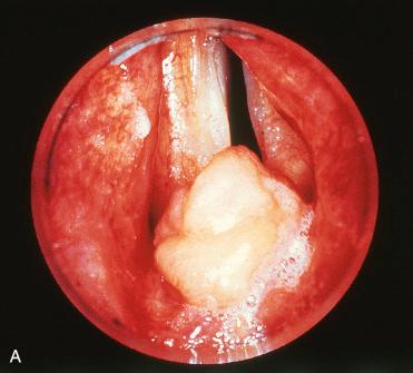 Fig. 16-12, Endoscopic appearance of granular cell tumor.