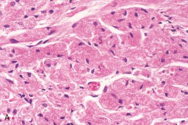 Fig. 16-13, Granular cell tumor.