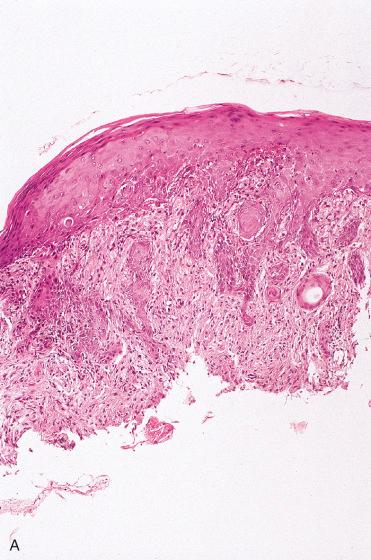 Fig. 16-14, Pseudoepitheliomatous hyperplasia and granular cell tumor.