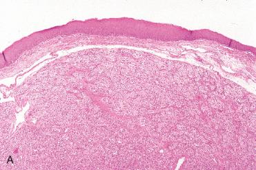 Fig. 16-15, Laryngeal paraganglioma.