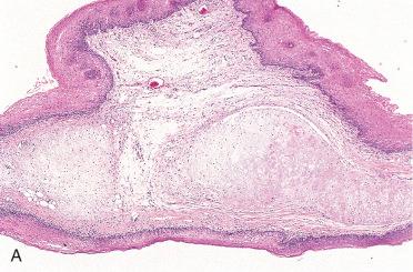 Fig. 16-17, Laryngeal chondroma.