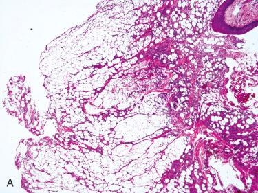 Fig. 16-18, Laryngeal lipoma.