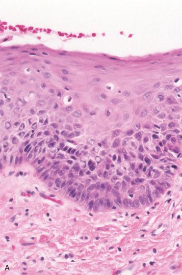 Fig. 16-19, Laryngeal nonkeratinizing dysplasia.