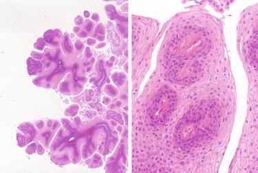 Fig. 16-2, Recurrent respiratory (laryngeal) papillomatosis.