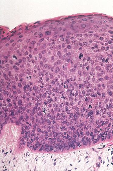 Fig. 16-21, Laryngeal keratinizing moderate dysplasia.