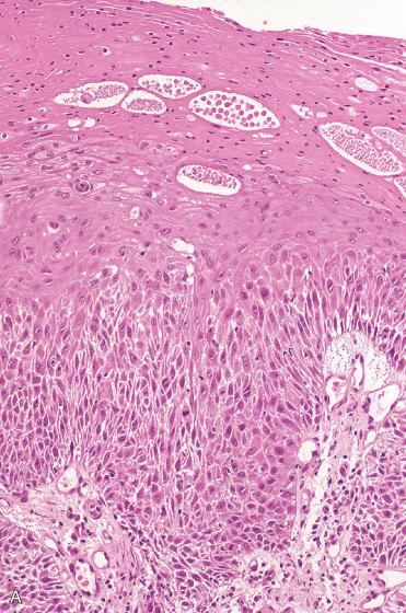 Fig. 16-22, Laryngeal keratinizing severe dysplasia.