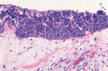 Fig. 16-23, Laryngeal “classic” carcinoma in situ (CIS).