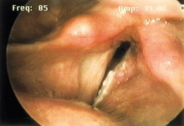 Fig. 16-24, Microinvasive carcinoma.