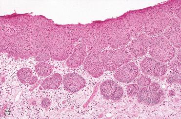 Fig. 16-25, Invasive squamous cell carcinoma.