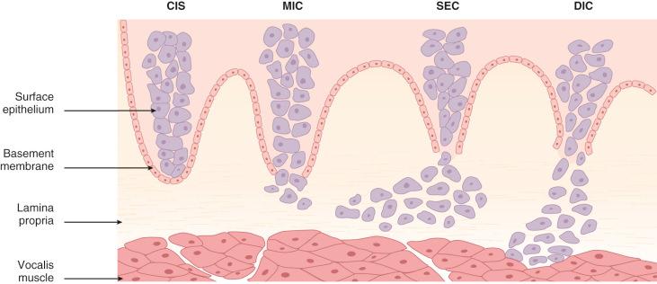 Fig. 16-27, Diagrammatic depiction of superficial extending carcinoma (SEC) compared with carcinoma in situ (CIS), microinvasive carcinoma (MIC), and deeply invasive carcinoma (DIC).