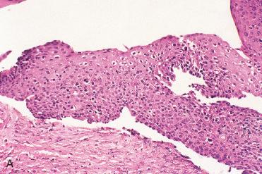 Fig. 16-3, Dysplasia in laryngeal papilloma.