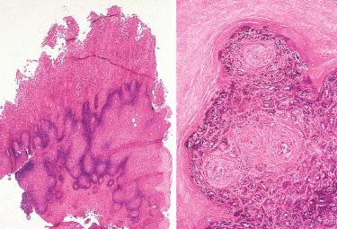 Fig. 16-6, Laryngeal verruca vulgaris.