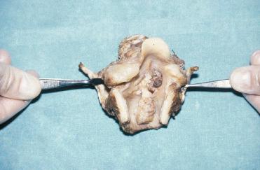 Fig. 16-8, Laryngeal inflammatory myofibroblastic tumor (IMT).