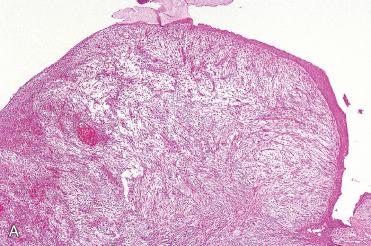 Fig. 16-9, Laryngeal IMT.