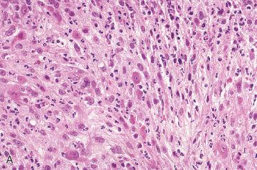 Fig. 16-10, Myofibroblasts in IMT.