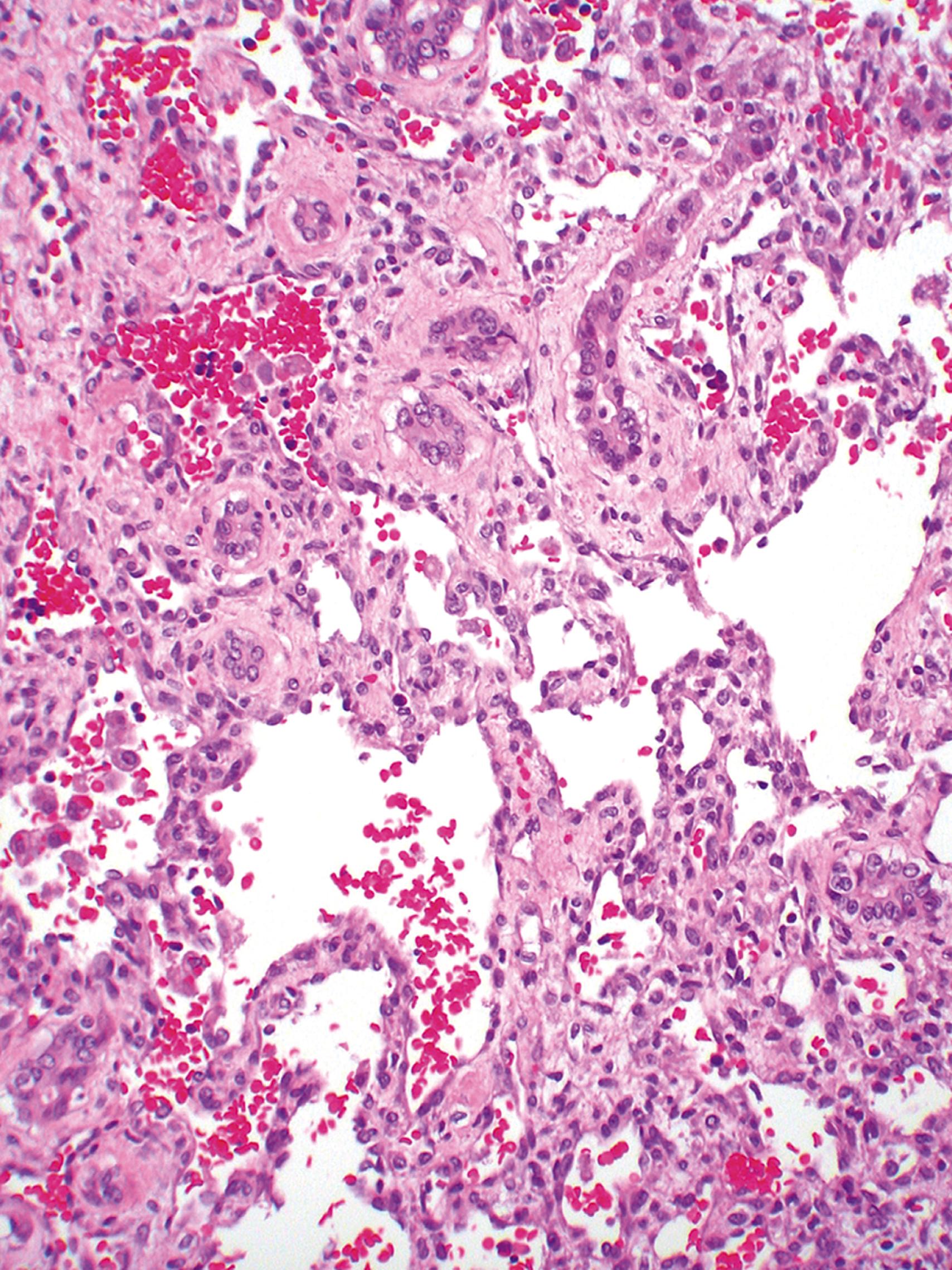 Fig. 48.1, Hepatic Hemangioma.