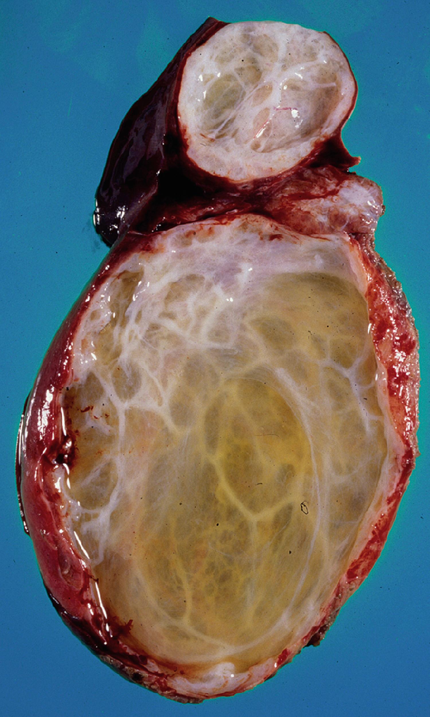 Fig. 48.2, Mesenchymal Hamartoma.