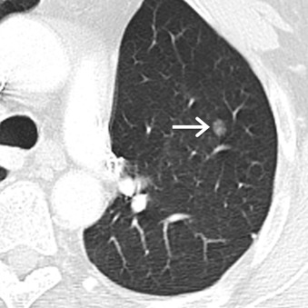 Figure 17.1, Collimated contrast-enhanced axial CT scan of a 64-year-old man with a history of adenocarcinoma of the left upper lobe status post–left upper lobectomy demonstrates a 9-mm ground-glass nodule (arrow) in the left lower lobe. Wedge resection revealed atypical adenomatous hyperplasia.