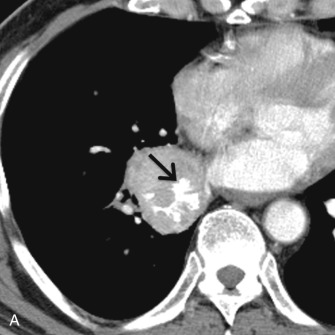 Figure 17.11, Imaging manifestations of carcinoid. (A) Collimated contrast-enhanced axial CT scan of a 70-year-old man demonstrates a soft tissue mass in the right lower lobe, with eccentric calcification (arrow) . Biopsy revealed carcinoid. (B) Collimated contrast-enhanced axial CT scan of a 46-year-old woman demonstrates a carcinoid tumor in the left lower lobe (white arrow) with extensive peripheral enhancement and vascularity (black arrow).