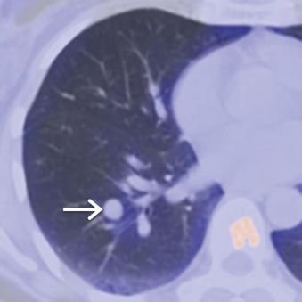 Figure 17.12, Collimated axial fused PET/CT image of a 47-year-old woman with a history of breast cancer demonstrates a well-circumscribed nodule (arrow) in the right lower lobe. FDG uptake within the nodule is similar to background. Biopsy revealed typical carcinoid.