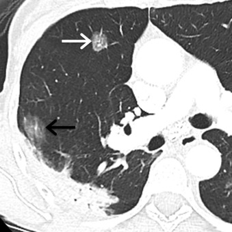 Figure 17.2, Collimated contrast-enhanced axial CT scan of a 68-year-old woman with a history of adenocarcinoma of the right lower lobe treated with chemoradiation therapy demonstrates a part solid nodule (white arrow) in the right middle lobe and a ground-glass nodule ( black arrow) in the right lower lobe. Biopsy of these nodules revealed adenocarcinoma in situ.