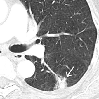 Figure 17.3, Collimated contrast-enhanced axial CT scan of a 73-year-old woman demonstrates a part solid nodule (arrow) in the left lower lobe, with both ground-glass and solid components. A left lower lobectomy was performed and revealed minimally invasive adenocarcinoma.