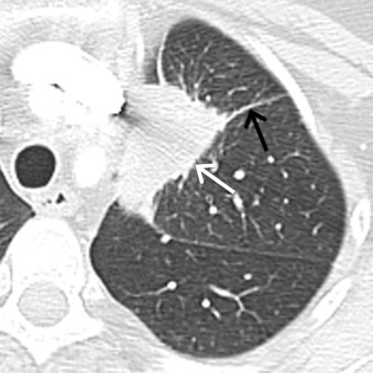 Figure 17.4, Collimated contrast-enhanced axial CT scan of a 43-year-old woman demonstrates a solid mass (white arrow) with irregular and spiculated margins in the left upper lobe. Note the presence of pleural tags (black arrow). Biopsy revealed invasive adenocarcinoma.