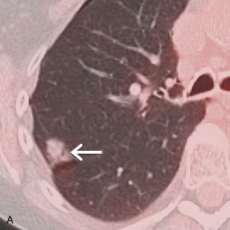 Figure 17.5, FDG-PET/CT of adenocarcinoma. (A) Collimated axial fused PET/CT image of a 52-year-old woman demonstrates a lobular nodule in the right lower lobe (arrow) with FDG uptake similar to that of the adjacent chest wall soft tissues. Biopsy revealed minimally invasive adenocarcinoma. (B) Collimated axial fused PET/CT image of a 67-year-old woman with a large soft tissue mass in the right lower lobe that is markedly FDG-avid. Biopsy revealed invasive adenocarcinoma.