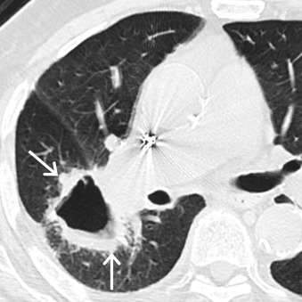 Figure 17.6, Collimated contrast-enhanced axial CT scan of a 92-year-old man demonstrates a large, thick-walled, cavitary mass (arrows) in the right lower lobe. Biopsy revealed squamous cell carcinoma of the lung.