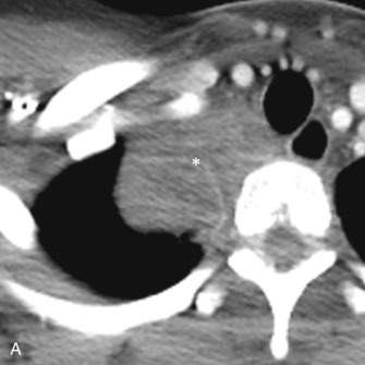 Figure 17.7, Pancoast tumor with chest wall invasion. (A) Collimated contrast-enhanced axial CT scan of a 19-year-old woman shows a soft tissue mass (asterisk) in the right lung apex, representing a primary Pancoast tumor. (B) Sagittal T2-weighted MR image of the same patient demonstrates invasion of the right chest wall (arrows) by the tumor (asterisk).