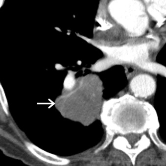 Figure 17.8, Collimated contrast-enhanced axial CT scan of a 74-year-old man demonstrates a large soft tissue mass (arrow) in the right lower lobe. Note the presence of internal vascularity. Biopsy revealed large cell neuroendocrine carcinoma.