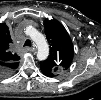 Figure 17.10, Superior vena cava obstruction due to small cell lung carcinoma (SCLC). Collimated contrast-enhanced axial CT scan of a 52-year-old man with SCLC demonstrates soft tissue in the right paratracheal region (asterisk) obliterating the superior vena cava. Note the collateral vessels in the left chest wall and mediastinum. A cavitary metastasis (arrow) is present in the left lung.