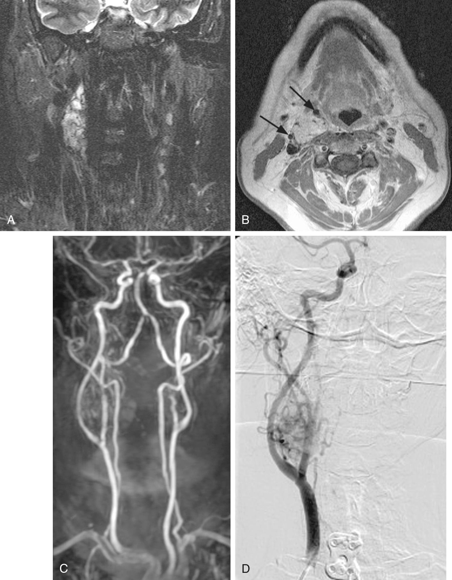 Fig. 115.1, Imaging of carotid paragangliomas.