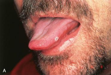 Fig. 6-1, Oral cavity squamous papillomas.