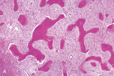 Fig. 6-12, Fibrous dysplasia.