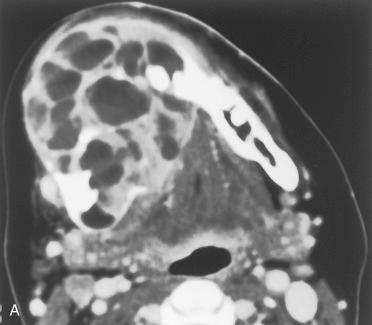 Fig. 6-13, Giant cell tumor.