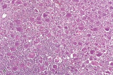 Fig. 6-14, Giant cell tumor.